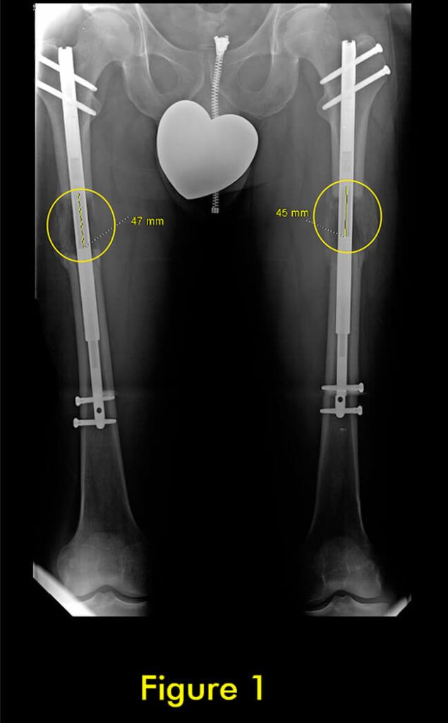 过早合并示意图1