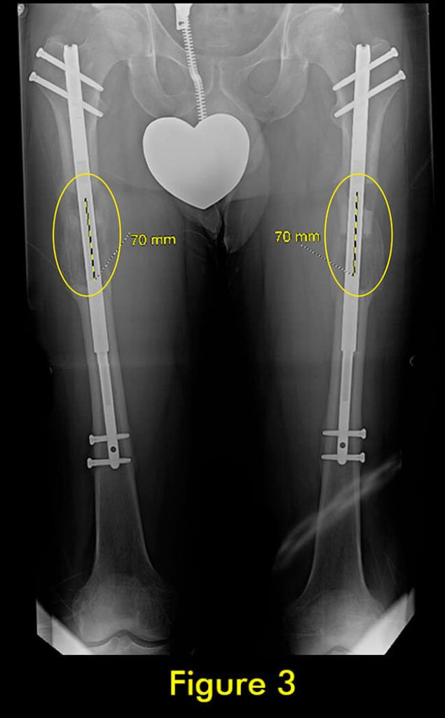 过早合并示意图3
