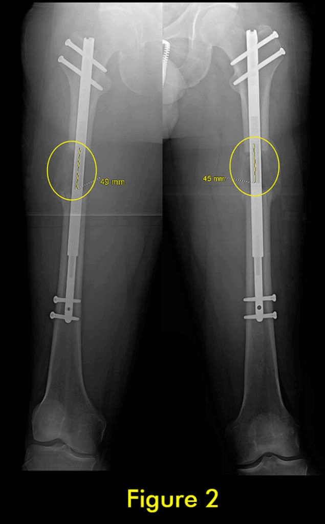 过早合并示意图2