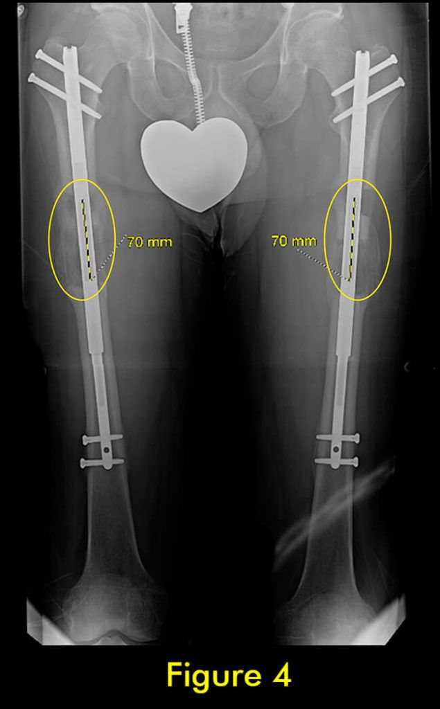 过早合并示意图4